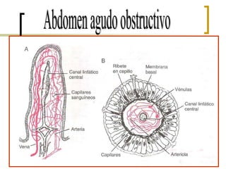 Abdomen agudo obstructivo 
