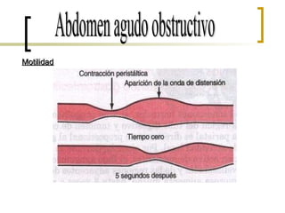 Abdomen agudo obstructivo Motilidad 