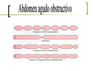 Abdomen agudo obstructivo 