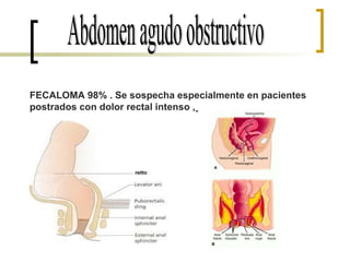 FECALOMA 98% . Se sospecha especialmente en pacientes postrados con dolor rectal intenso ,   Abdomen agudo obstructivo 