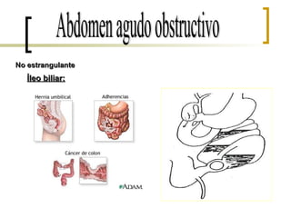 Abdomen agudo obstructivo Íleo biliar: No estrangulante 