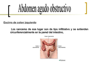 Abdomen agudo obstructivo Escirro de colon izquierdo Los canceres de ese lugar son de tipo infiltrativo y se extienden circunferencialmente en la pared del intestino,  