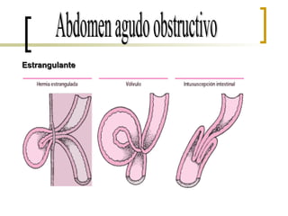 Abdomen agudo obstructivo Estrangulante 