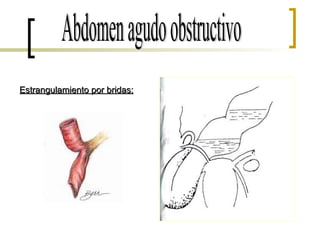 Abdomen agudo obstructivo Estrangulamiento por bridas: 