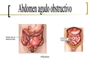 Abdomen agudo obstructivo 