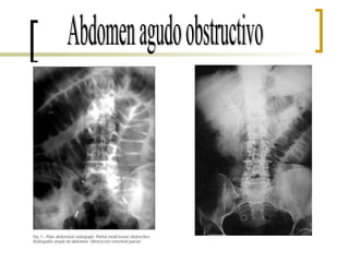 Abdomen agudo obstructivo 