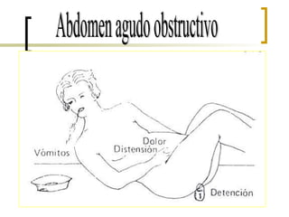 Abdomen agudo obstructivo 