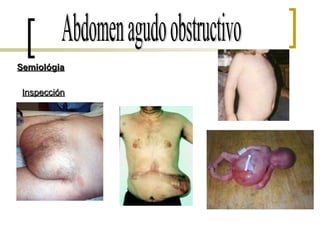 Abdomen agudo obstructivo Semiológia Inspección 