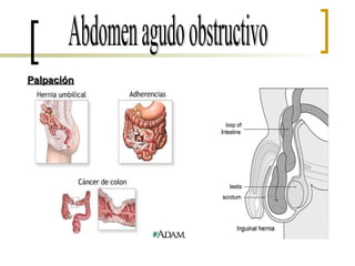 Abdomen agudo obstructivo Palpación 