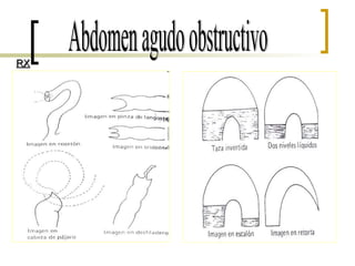 Abdomen agudo obstructivo RX 