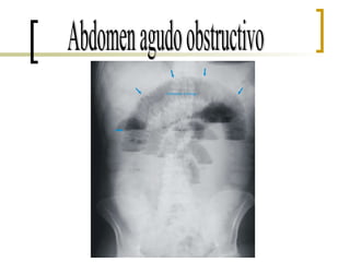 Abdomen agudo obstructivo 