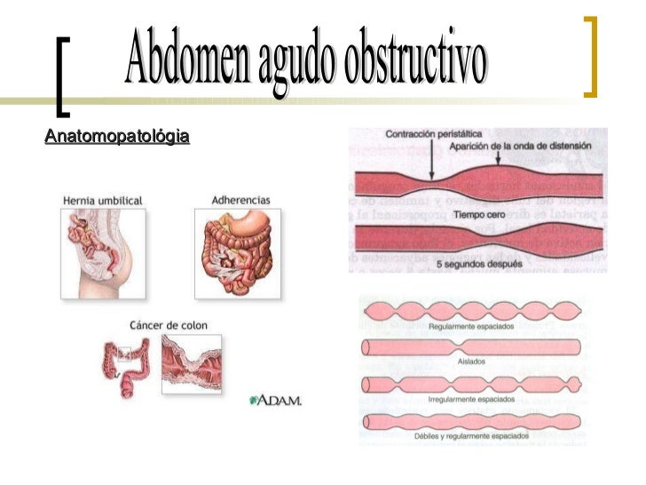 Abdomen Agudo Obstructivo Seminario
