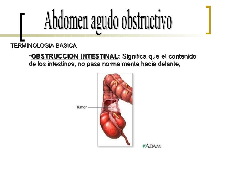 Abdomen Agudo Obstructivo Seminario