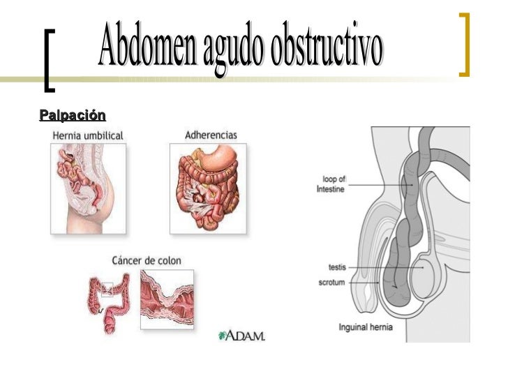 Abdomen Agudo Obstructivo Seminario