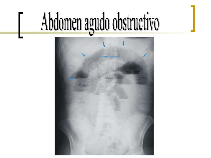 Abdomen Agudo Obstructivo Seminario