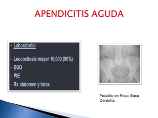 Fecalito en Fosa Ilíaca
Derecha.
 