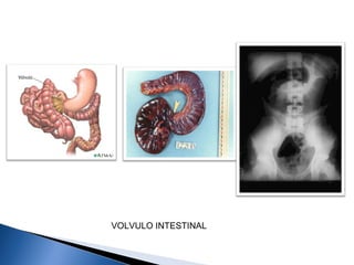 VOLVULO INTESTINAL
 