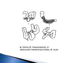 a: hernia, b: intususcepción, c:
obstrucción intestinal por bridas, d: óvulo
 