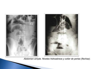 Abdomen simple. Niveles hidroaéreos y collar de perlas (flechas).
 
