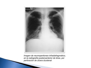 Imagen de neumoperitoneo infradiafragmático,
en la radiografía posteroanterior de tórax, por
perforación de úlcera duodenal.
 