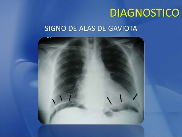Abdomen agudo perforativo