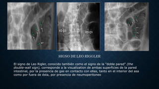 Abdomen Agudo Perforativo con Enfoque al Manejo del ulcus Perforado | PPTX