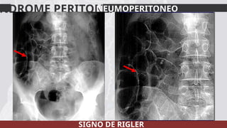 Sdinal De Rigler Caracterización del abdomen agudo quirúrgico | PPTX