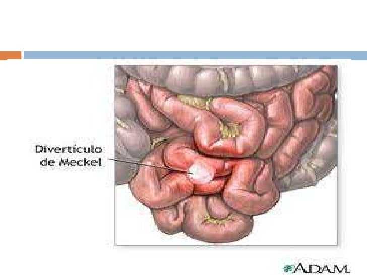 Abdomen agudo quirurgico en pediatria Abdomen agudo quirurgico en pediatria