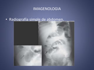 IMAGENOLOGIA
• Radiografía simple de abdomen.
 
