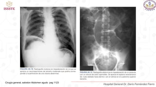 Cirugía general, sabiston Abdomen agudo pag 1123
Hospital General Dr. Darío Fernández Fierro
 