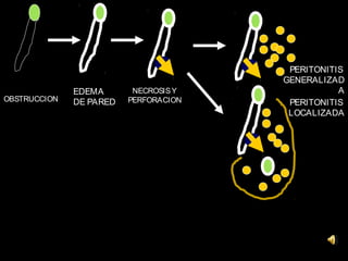 PERITONITIS
                                       GENERALIZAD
              EDEMA       NECROSIS Y              A
OBSTRUCCION   DE PARED   PERFORACION    PERITONITIS
                                        LOCALIZADA
 