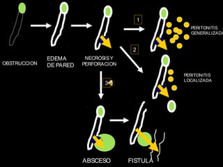 1
                                                   PERITONITIS
                                                   GENERALIZADA


                                        2
              EDEMA       NECROSIS Y
OBSTRUCCION   DE PARED   PERFORACION

                                                 PERITONITIS
                                                 LOCALIZADA
                                3




                         ABSCESO       FISTULA
 