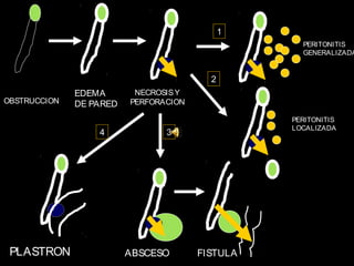 1
                                                   PERITONITIS
                                                   GENERALIZADA


                                         2
              EDEMA       NECROSIS Y
OBSTRUCCION   DE PARED   PERFORACION

                                                 PERITONITIS
                                                 LOCALIZADA
                  4             3




 PLASTRON                ABSCESO       FISTULA
 