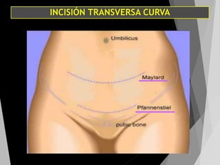INCISIÓN TRANSVERSA CURVA
 