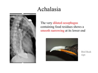 Achalasia
The very dilated oesophagus
containing food residues shows a
smooth narrowing at its lower end
Bird Beak
sign
 