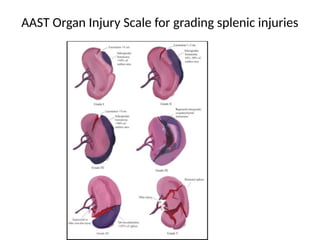 Splenic Injury Classification Comprehensive Management of Abdominal Injuries in Trauma Care | PPTX