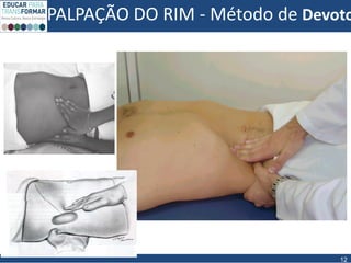PALPAÇÃO DO RIM - Método de Devoto
12
 
