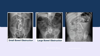 AP Erect Right posterior oblique Left lateral decubitus
 