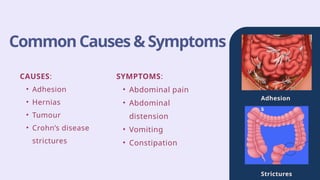 Adhesion
s
Strictures
Common Causes & Symptoms
CAUSES:
• Adhesion
• Hernias
• Tumour
• Crohn’s disease
strictures
SYMPTOMS:
• Abdominal pain
• Abdominal
distension
• Vomiting
• Constipation
 