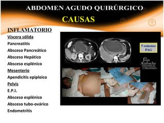 INFLAMATORIO
Víscera sólida
Pancreatitis
Absceso Pancreático
Absceso Hepático
Absceso esplénico
Mesenterio
Apendicitis epiploico
Pelvis
E.P.I.
Absceso esplénico
Absceso tubo-ovárico
Endometritis
CAUSAS
 