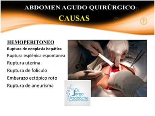 HEMOPERITONEO
Ruptura de neoplasia hepática
Ruptura esplénica espontanea
Ruptura uterina
Ruptura de folículo
Embarazo ectópico roto
Ruptura de aneurisma
CAUSAS
 