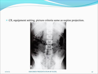  CR, equipment setting, picture criteria same as supine projection.




11/01/12            ABDOMEN PRESENTATION BY SUDIL                       42
 