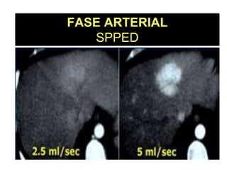 FASE ARTERIAL
   SPPED
 