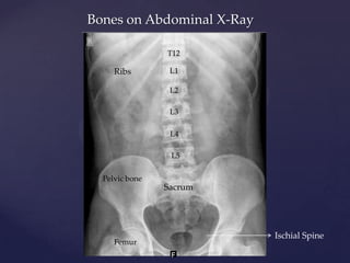 Bones on Abdominal X-Ray
L1
L2
L3
L4
L5
Ribs
Sacrum
Pelvic bone
Femur
T12
Ischial Spine
 
