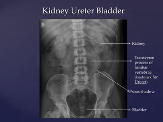 Kidney Ureter Bladder
Kidney
Transverse
process of
lumbar
vertebrae
(landmark for
Ureter)
Bladder
Psoas shadow
 