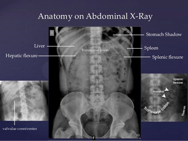 Abdominal X Ray Anatomy