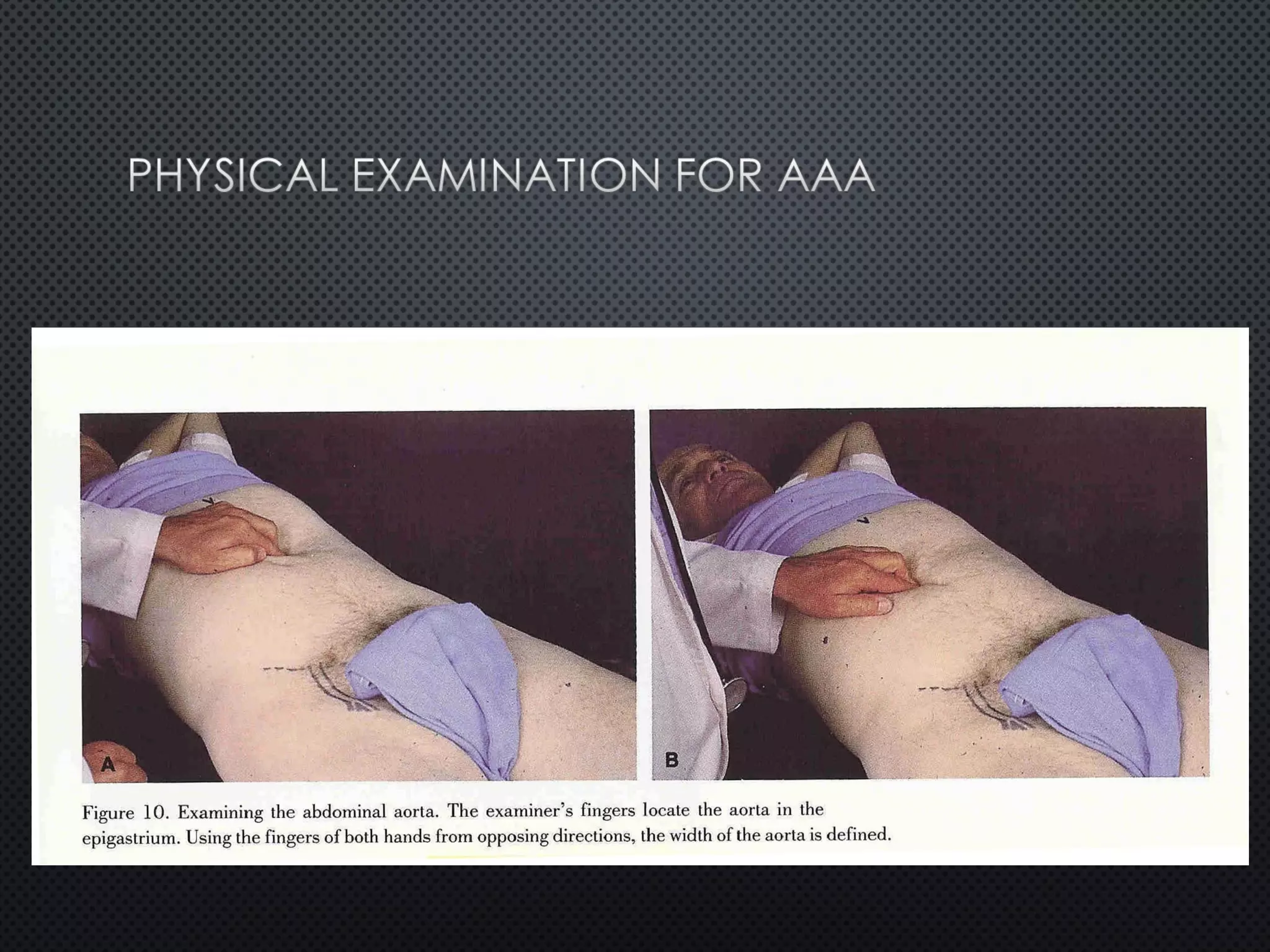 Abdomianl Aortic Aneurysm (AAA) | PPT