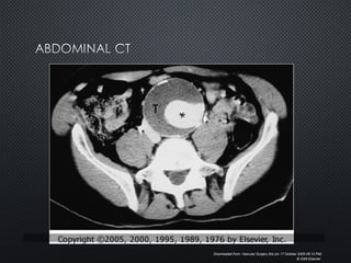 Downloaded from: Vascular Surgery 6/e (on 17 October 2005 08:13 PM)
© 2005 Elsevier
 