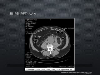 Downloaded from: Vascular Surgery 6/e (on 17 October 2005 11:17 PM)
© 2005 Elsevier
 