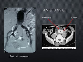 Angio = luminogram
thrombus lumen
 